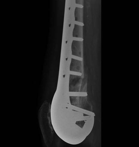 Periprosthetic TKR Locking Plate Nonunion 2